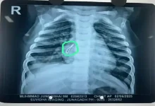 Doctors remove LED bulb from infant’s lung at Ahmedabad Civil Hospital during Pediatric Surgery Week in a life-saving operation.