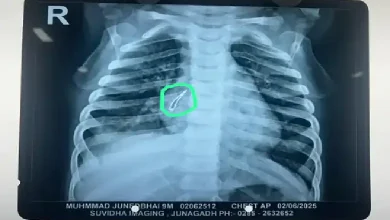 Doctors remove LED bulb from infant’s lung at Ahmedabad Civil Hospital during Pediatric Surgery Week in a life-saving operation.