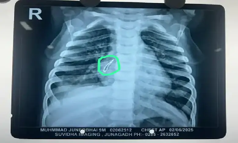 Doctors remove LED bulb from infant’s lung at Ahmedabad Civil Hospital during Pediatric Surgery Week in a life-saving operation.
