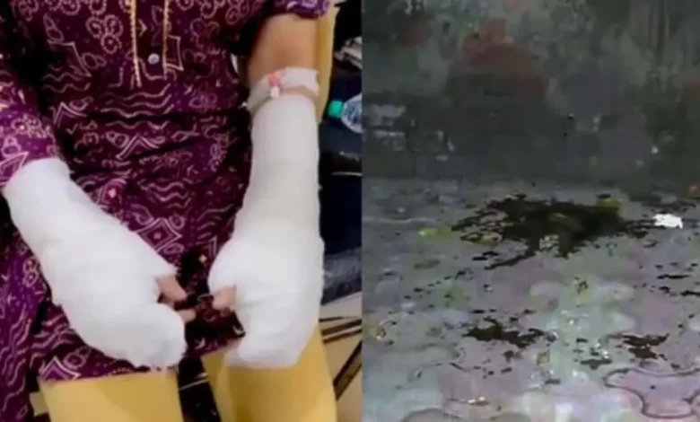 Delhi Acid Attack Case Sees New Twist: Police Question Key Suspect’s Location; No Cctv or Acid Traces