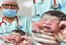 In One-in-a-Million Birth, Brazilian Newborn Arrives Clutching the IUD Meant to Prevent His Pregnancy