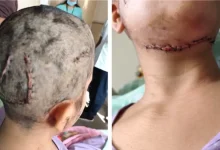 A woman was seriously injured after being attacked by a pet dog during her morning walk in Bengaluru’s HSR Layout on January 26.