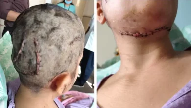 A woman was seriously injured after being attacked by a pet dog during her morning walk in Bengaluru’s HSR Layout on January 26.