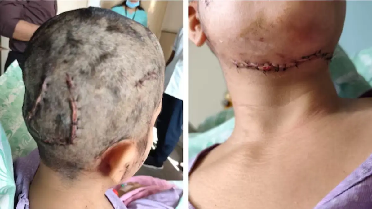 A woman was seriously injured after being attacked by a pet dog during her morning walk in Bengaluru’s HSR Layout on January 26.