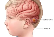 World Brain Tumor Day 2026: When A Headache Changes Everything The Hidden Stories Behind One Of The World's Most Misunderstood Diseases
